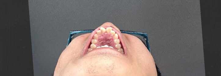 セラミック治療前の前歯2本（出っ歯＆すきっ歯）の裏側