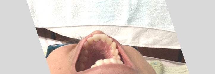 セラミック治療後の前歯2本の裏側